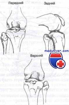 вывих головки малоберцовой кости
