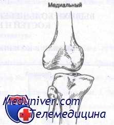 передний вывих коленного сустава