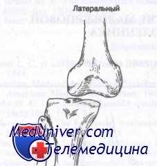 передний вывих коленного сустава