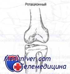 передний вывих коленного сустава