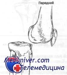 передний вывих коленного сустава
