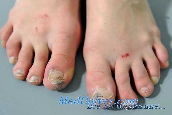 болезни ног артистов