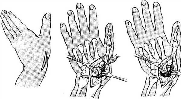 хирургическое вмешательство при повреждении кисти