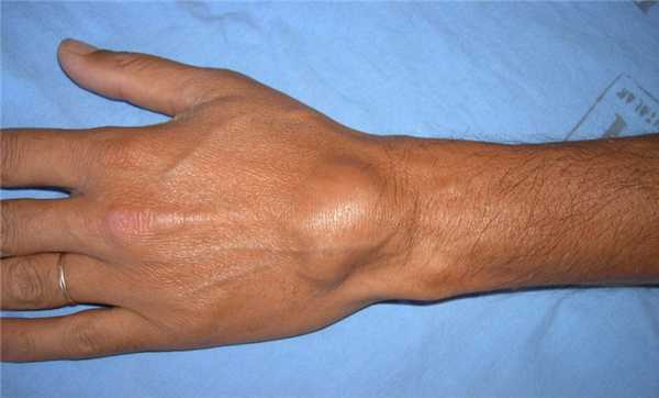 гигрома лучезапястного сустава