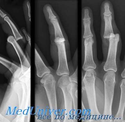 вывихи в межфаланговых суставах