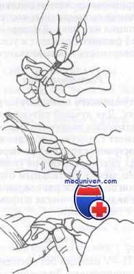переломы и вывихи пальцев стопы