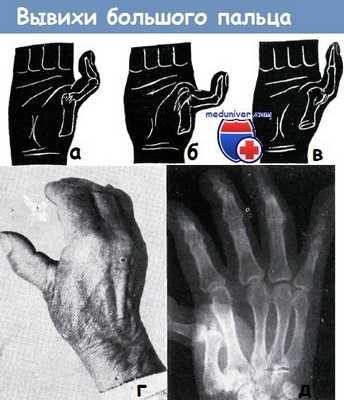 Вывихи большого пальца кисти