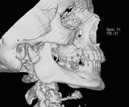 вывих нижней челюсти