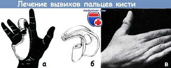 Лечение вывихов пальцев кисти