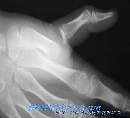 вывих в пястно-фаланговом суставе