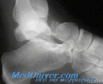 вывих таранной кости