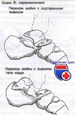 переломовывих таранной кости