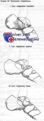 большие переломы таранной кости