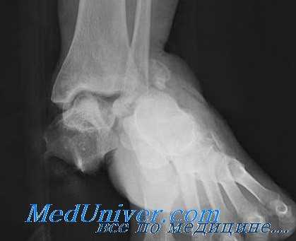 большие переломы таранной кости