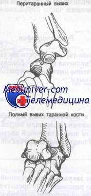 вывих таранной кости