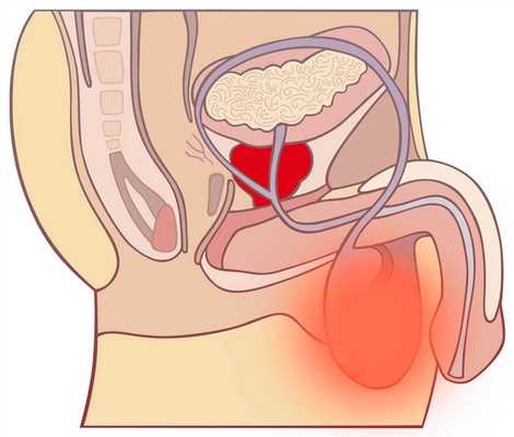 воспаление мочеполовых путей