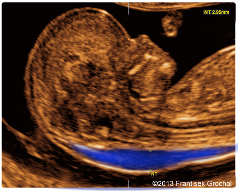 Фотография УЗИ плода голова и часть тела, на которой синим цыетом показано место определения толщины воротникового пространства