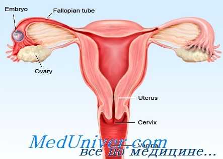 внематочная беременность
