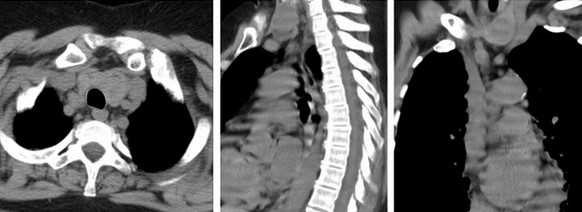 КТ средостения, аксиальная, сагиттальная и фронтальная проекции