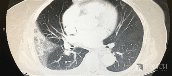 Исследование органов грудной клетки: КТ с контрастом