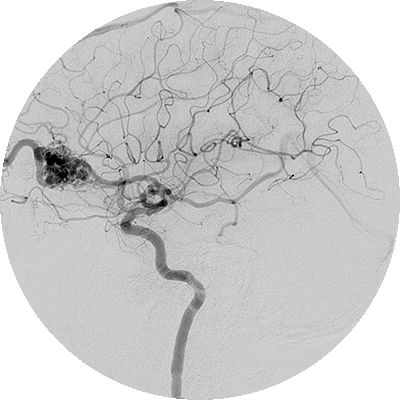 Ангиография - когда назначается и как проходит исследование в Клинике ЕвразияМед 