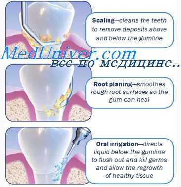 шинирование при парадонтите