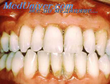 шинирование при парадонтите