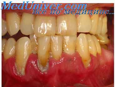 окклюзионные шины