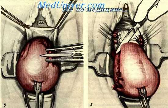 влагалищная ампутация матки