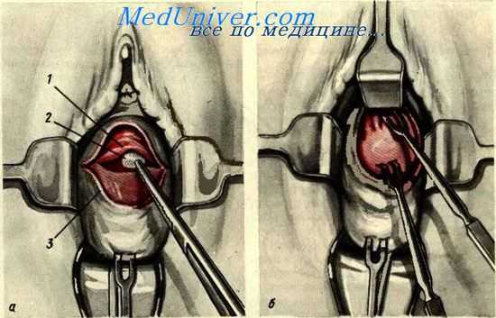 влагалищная ампутация матки