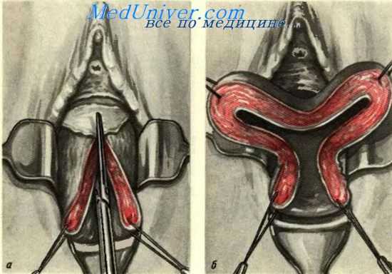 влагалищная экстирпация матки