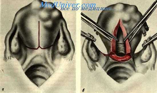 Надвлагалищная ампутация матки с сохранением части эндометрия