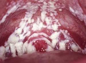 Бели при молочнице