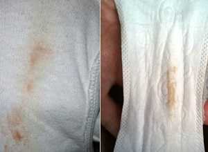 Бели желтого цвета на трусах