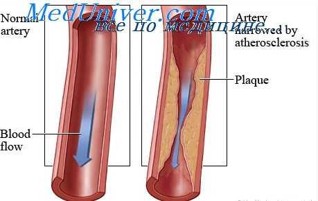 гиперхолестеринемия