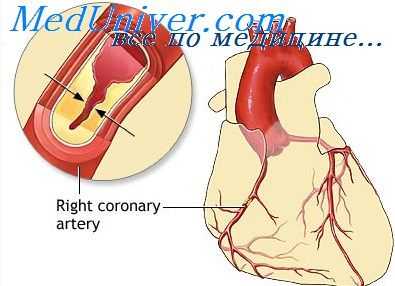 алкогольный атеросклероз