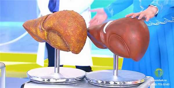 Влияние алкоголя на печень