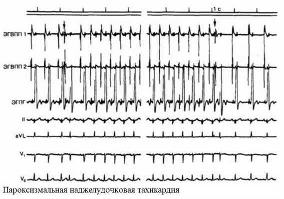 Пароксизмальная наджелудочковая тахикардия