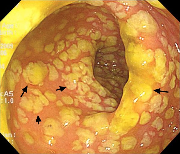 Бляшки при ПМК [35]