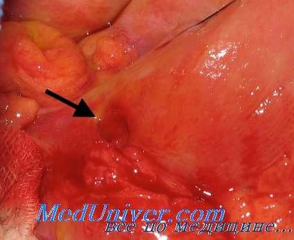 стероидная язва желудка