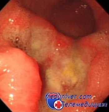 язва желудка