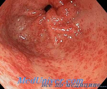 язвенная болезнь желудка