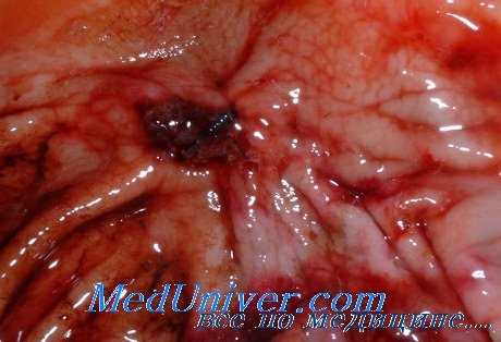 язвенная болезнь желудка