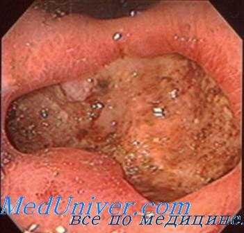 влияние эндокринных желез на желудок