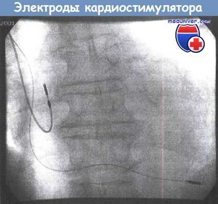 Электроды кардиостимулятора