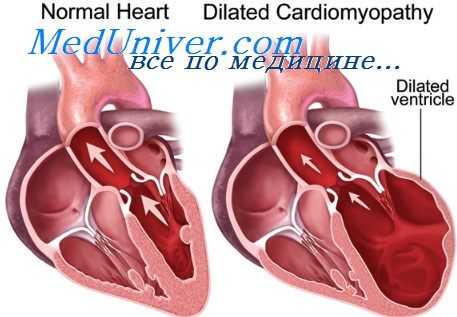 сердце при алкоголизме