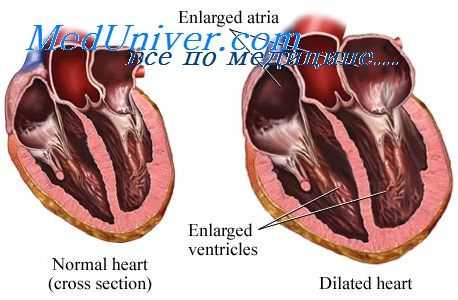 сердце при алкоголизме