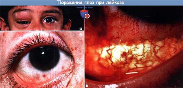 Поражение глаз при лейкозе