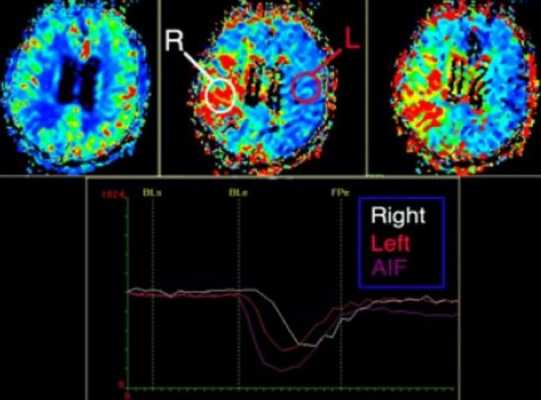 инсульт-перфузия