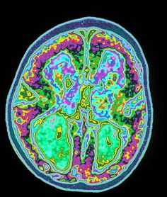 МР-перфузия головного мозга